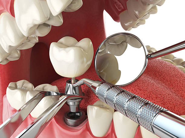 Best Emergency Root Canal Treatment in Dillsboro, IN